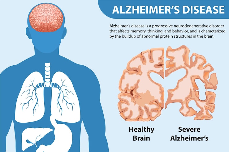 Vettore gratuito poster informativo della malattia di alzheimer