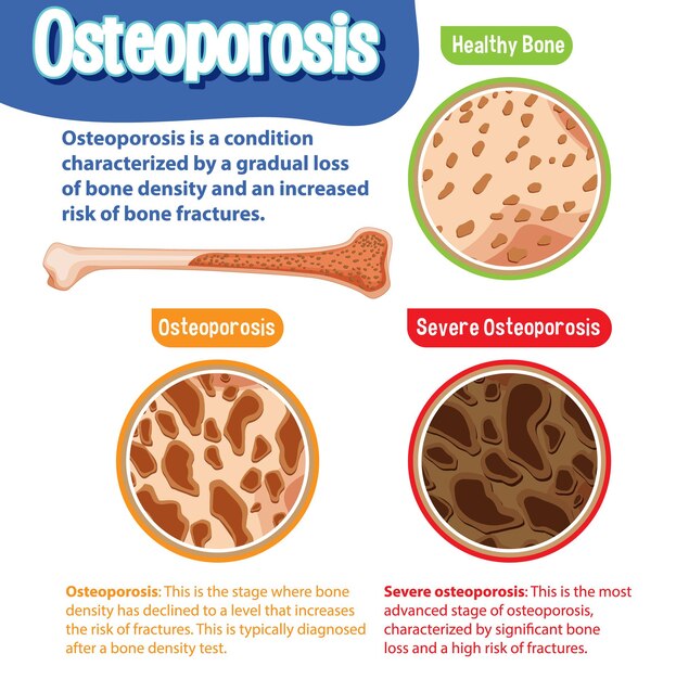 Poster informativo sull'osteoporosi ossea umana