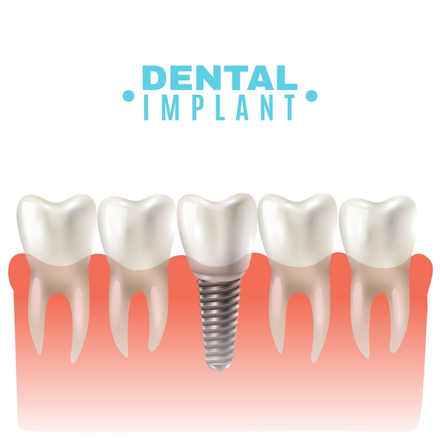 Poster per vista laterale modello di impianto dentale