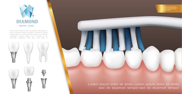 Realistico concetto di salute dentale con pulizia dei denti o processo di spazzolatura e impianti dentali