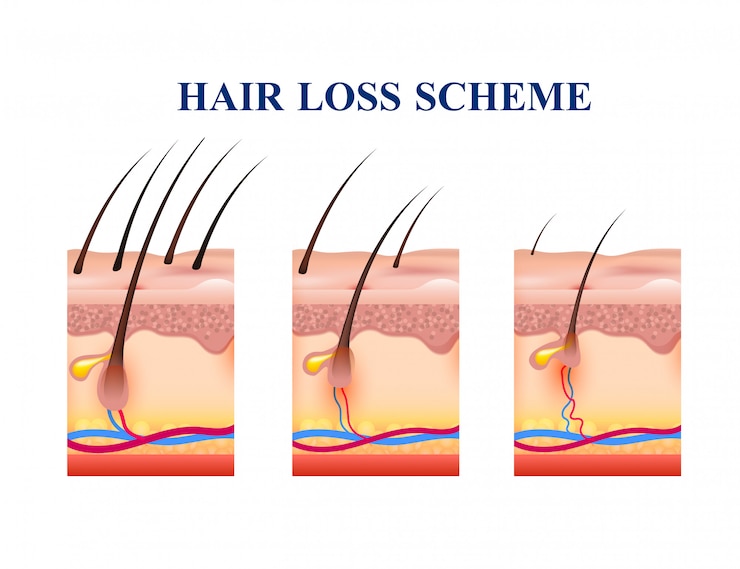 Vettore gratuito schema di perdita dei capelli