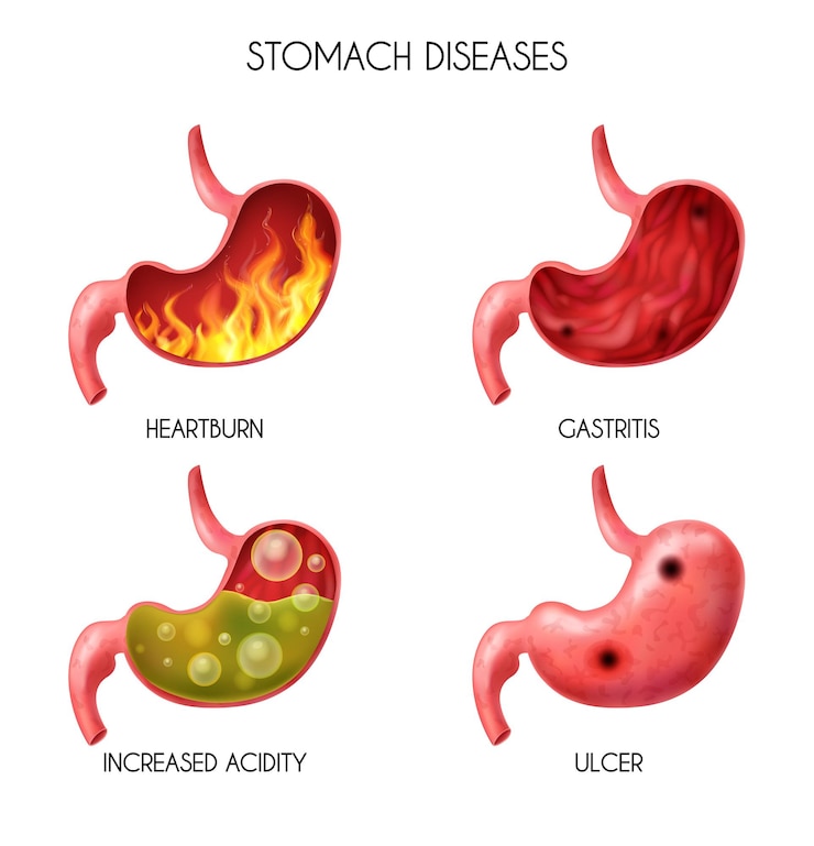 Vettore gratuito set di icone realistiche per lo stomaco dell'organo interno umano pirosi fuoco disturbo reflusso acido gastrico palla gonfia addominale illustrazione nausea