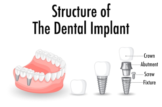 Struttura dell'impianto dentale su sfondo bianco