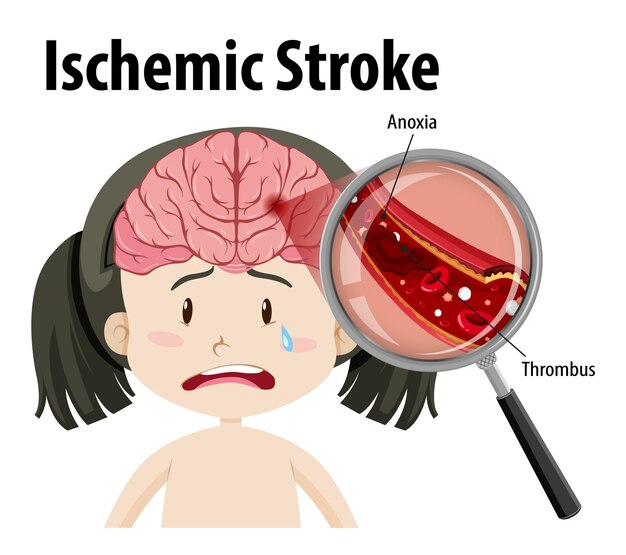 Umano con ictus ischemico