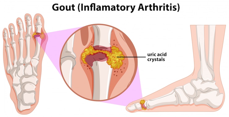 Vettore gratuito un'anatomia umana della gotta