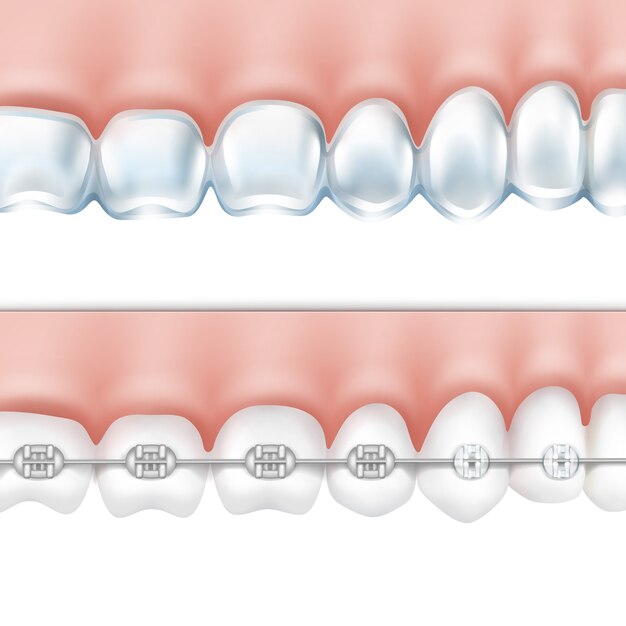 Vector denti umani con parentesi graffe metalliche e vista laterale vassoio sbiancante isolato su priorità bassa bianca