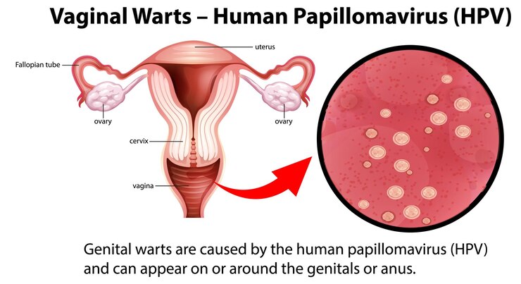 Vettore gratuito verruche vaginali infografica hpv del papillomavirus umano con espl