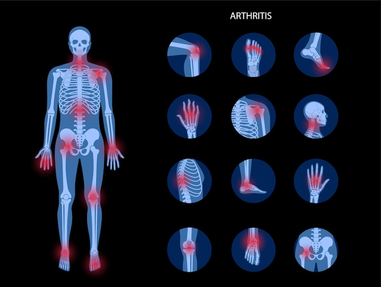 Artrite reumatoide, infiammazione, malattia ossea. Set con colonna vertebrale, ginocchio, polso e altre articolazioni