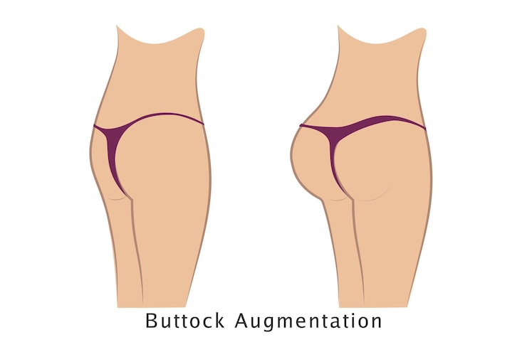 Vettore aumento dei glutei (gluteoplastica)