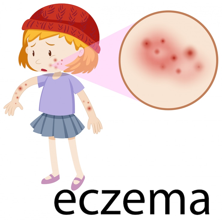 Vettore bambino piccolo con eczema ingrandito