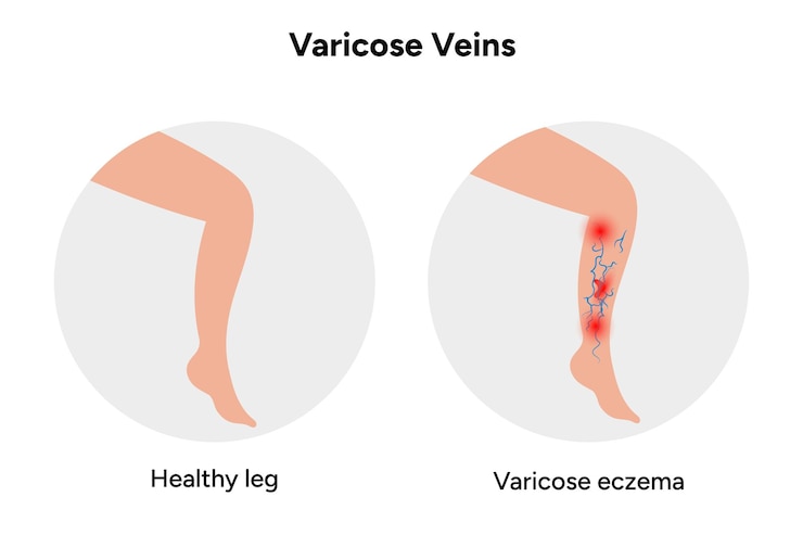 Vettore calze per la compressione delle vene varicose