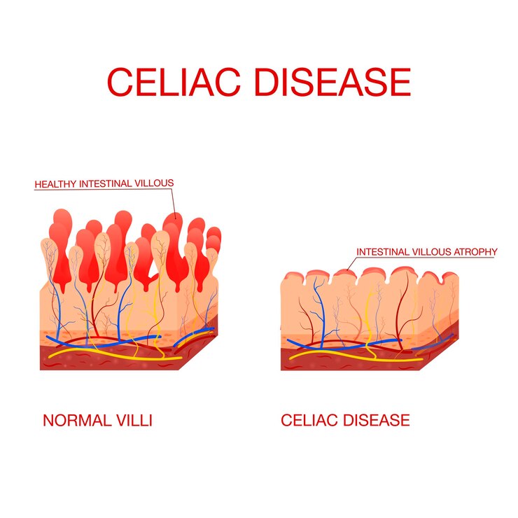 Celiachia o celiachia Villi sani e danneggiati