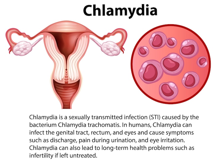 Vettore chlamydia trachomatis con spiegazione