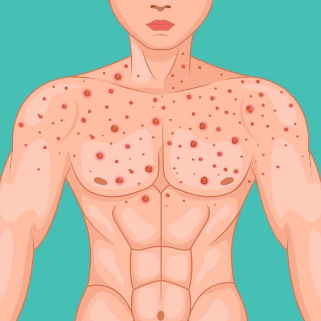 Corpo maschile affetto da eruzione cutanea con vesciche a causa di Monkeypox o altre infezioni virali