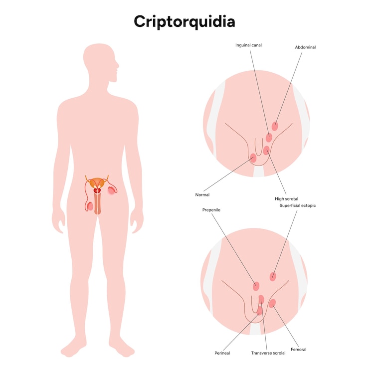 Vettore criptorquidia malattia dei testicoli criptorchidismo maschile dolore problema di patologia dei testicolo