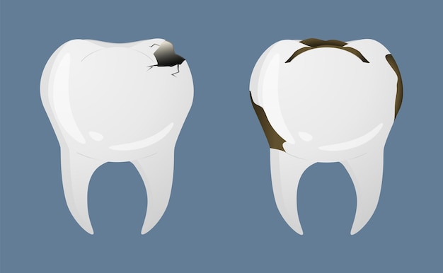 Denti in stile realistico Icone di carie dentali Illustrazione vettoriale colorata isolata sullo sfondo