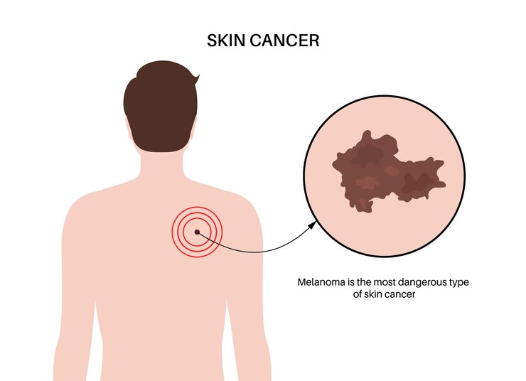 Diagnosi del cancro della pelle