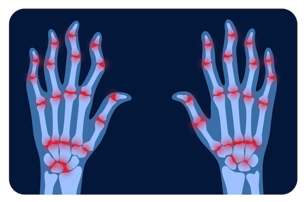 Dolore e infiammazione in mano ai raggi x. Sintomo di artrite reumatoide sulle articolazioni umane