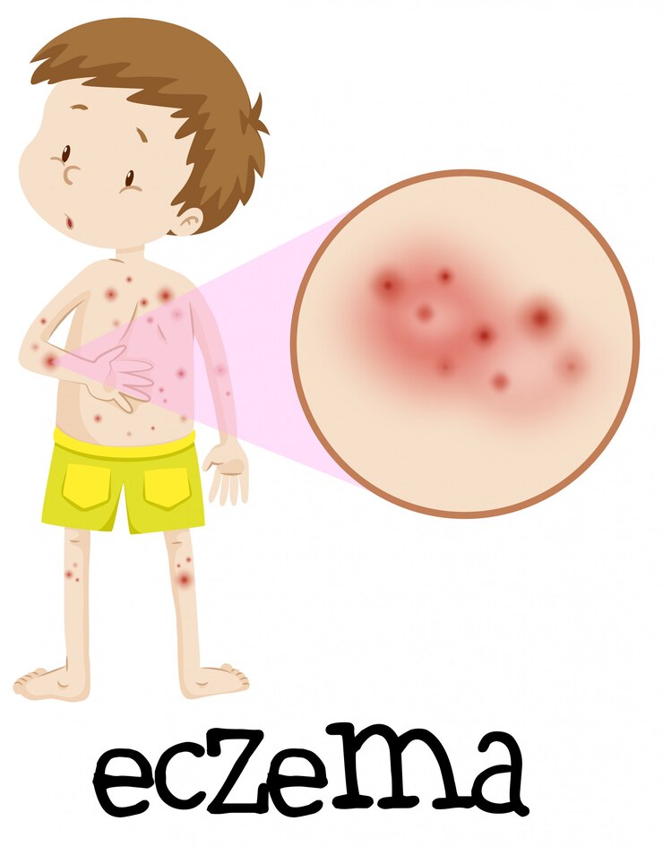 Vettore educazione medica umana di eczema