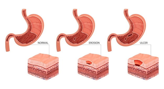 Erosione dello stomaco e illustrazione dell'ulcera