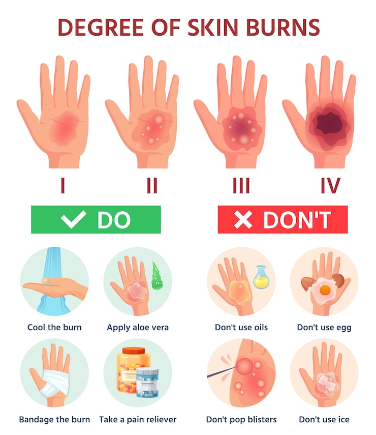 Vettore grado di ustione. pronto soccorso per ustione. classificazione dei danni da fuoco alla pelle. vesciche alle mani. trattamento infografico vettoriale per ferita termica. illustrazione lesioni dolore danni, aiuto medicina