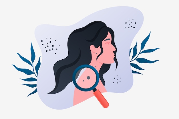 Illustrazione del melanoma a gradiente