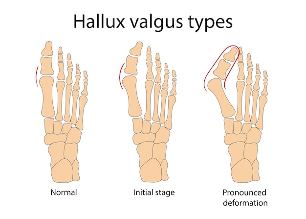 Illustrazione medica di vettore dell'infografica dell'alluce valgo