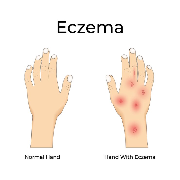Vettore illustrazione vettoriale di progettazione dell'eczema sulle mani