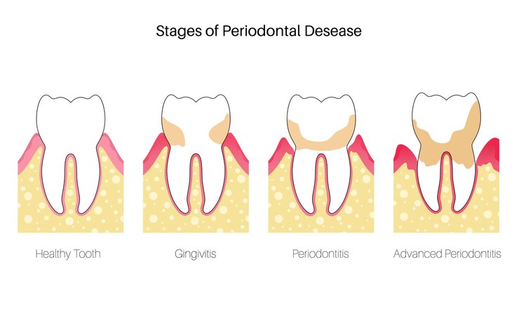Illustrazione vettoriale piatto isolato di parodontite. Infografica di anatomia del dente.