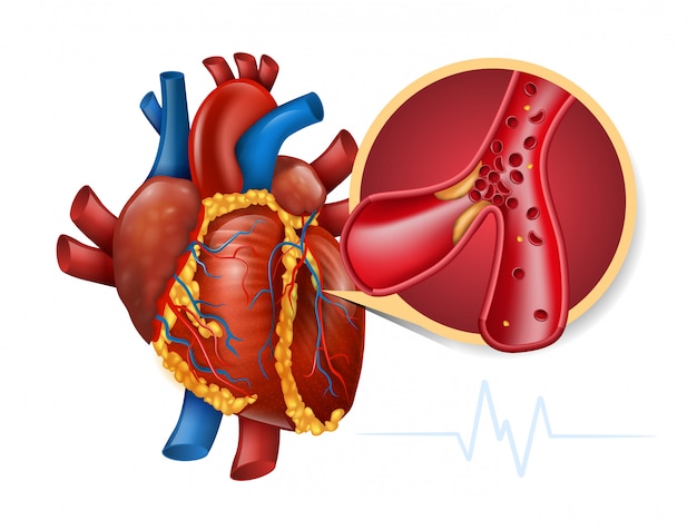 Infarto miocardico