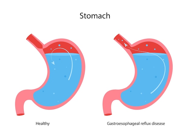 Malattia da reflusso gastroesofageo stomaco GERD bruciore di stomaco Organo interno normale e stomaco con Aci