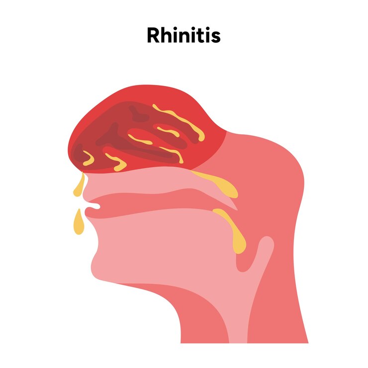 Vettore malattie nasali sintomi di rinite allergia rinite raffreddore diagramma medico