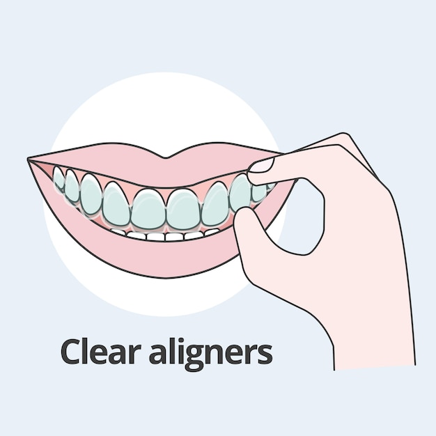 Mano che indossa allineatori trasparenti Illustratore vettoriale ortodontista