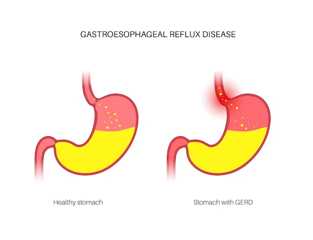 Poster della malattia da reflusso gastroesofageo. Stomaco sano e infiammazione da GERD nel corpo umano. Dolore, bruciore di stomaco al torace, allo stomaco e all'esofago. Lo sfintere aperto consente l'illustrazione vettoriale piatta del reflusso acido