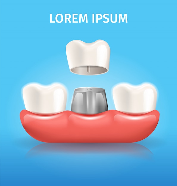 Poster dentale di vettore realistico della corona del dente