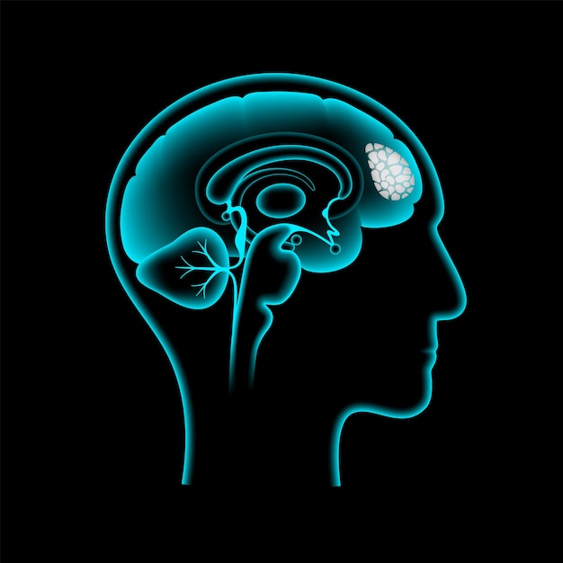 Poster sul cancro al cervello