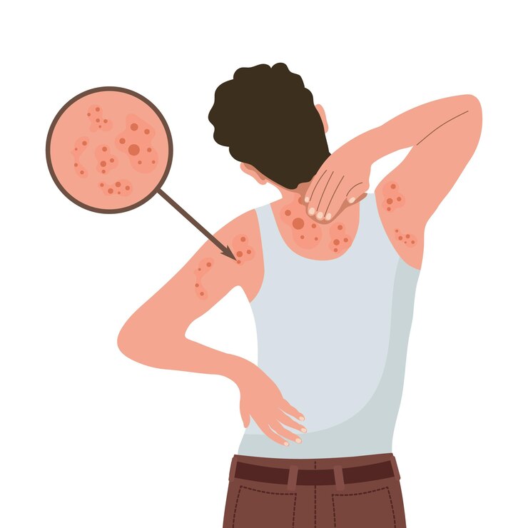 Vettore prurito allergico, infiammazione della pelle, arrossamento e irritazione, dermatite atopica, eczema, psoriasi