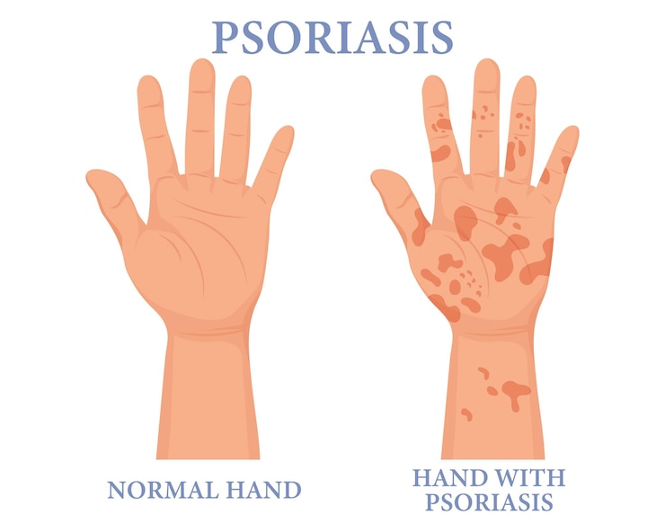 Vettore psoriasi, mano sana e malsana. dermatologia. il concetto di medicina e assistenza sanitaria. manifesto,