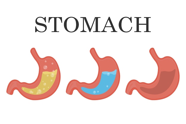 Sano e malsano stomaco umano vuoto e pieno reflusso del succo gastrico Nutrizione mal di stomaco