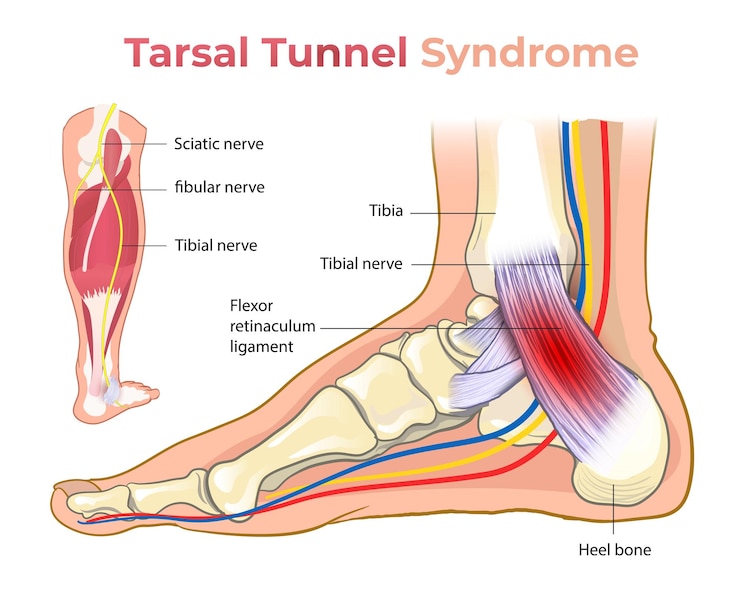 Vettore sindrome del tarsal_tunnel