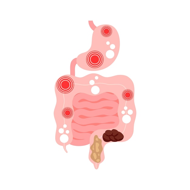 Sindrome dell'intestino irritabile IBS Sintomi nell'intestino e dolore allo stomaco gonfiore, flatulenza e diarrea