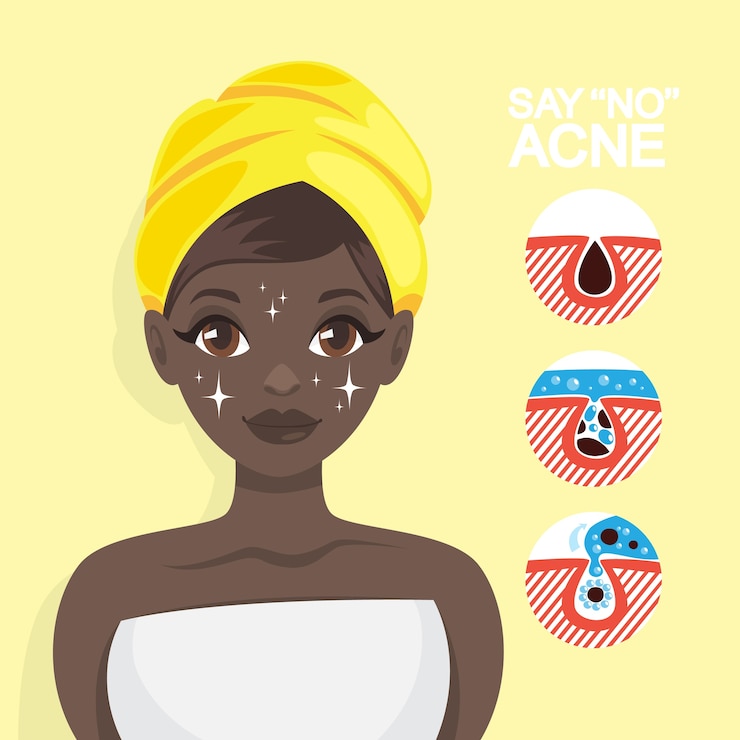 Vettore trattamento acne con maschera viso. idea di bellezza