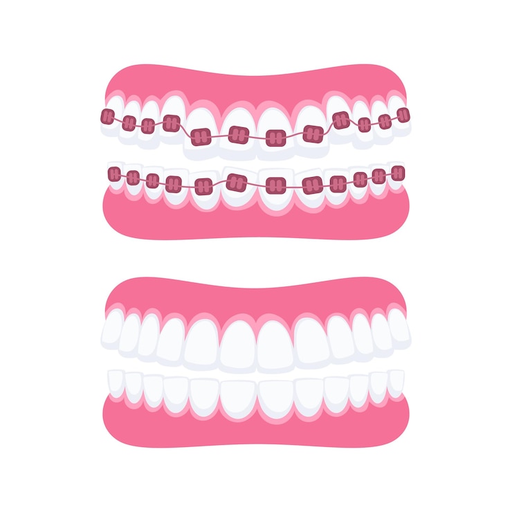 Vettore trattamento ortodontico che mostra i denti con e senza apparecchi dentali