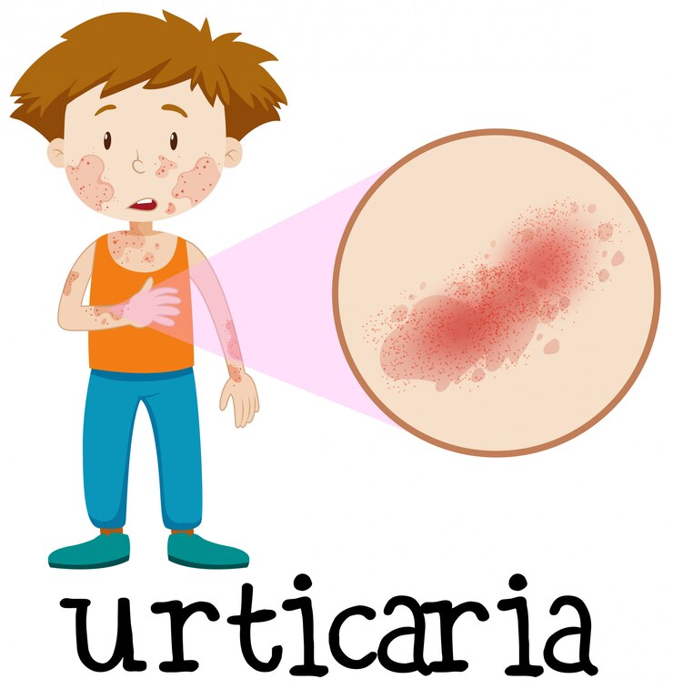 Vettore un vettore di orticaria della pelle