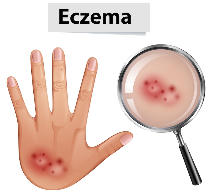 Vettore una mano umana con eczema