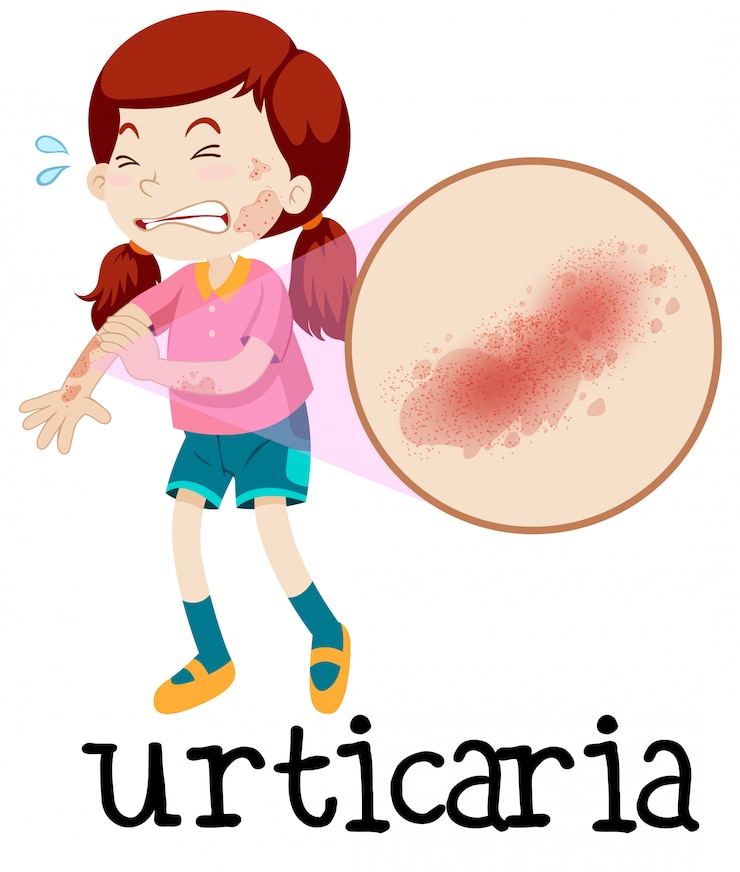 Vettore una ragazza con orticaria su sfondo bianco