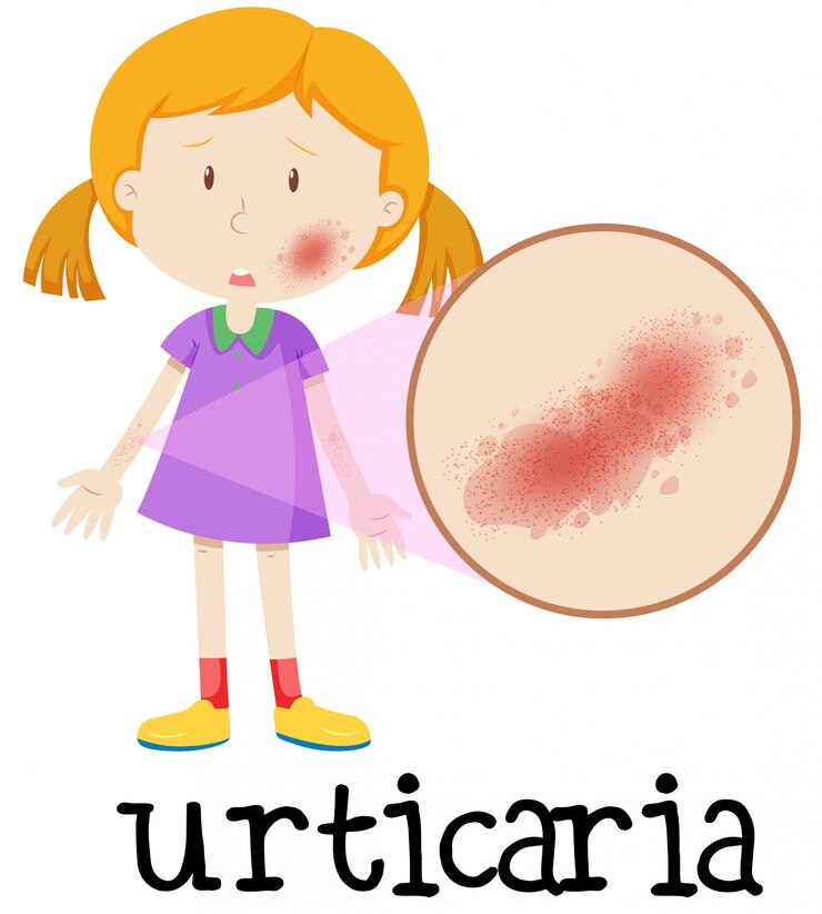 Vettore una ragazza con orticaria sulla pelle