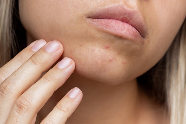 Bijgesneden opname van het gezicht van een jonge vrouw met het probleem van acne puistjes op de kin allergieën uitslag