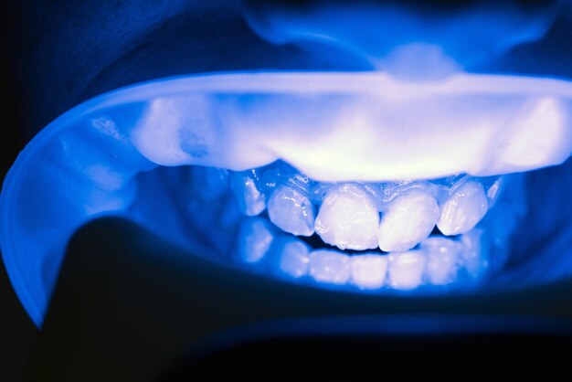 Bleken van de tanden bij tandartskliniek. uv whitening tanden. repareer gebarsten of gebroken tanden en verwijder tanden.