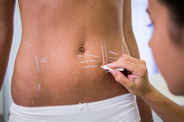 Chirurg tekent lijnen op de buik van de vrouw voor liposuctie en verwijdering van cellulitis